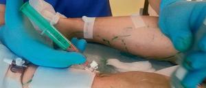 Bei der Behandlung. Der Berliner Venenarzt Johann Ragg setzt verschiedene Mikrotechniken ein. Mit einer Kombination aus Laser – und Verödungstechnik will er die Venenprobleme seiner Patienten in den Griff bekommen.