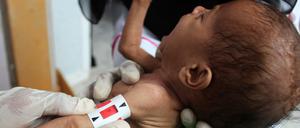 Millionen Babys und Kleinkinder leiden Hunger. Mütter sind oft zu entkräftet, um zu stillen.