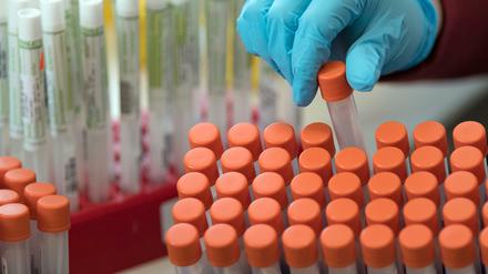 Proben von Coronavirus-Tests werden für die Untersuchung vorbereitet.
