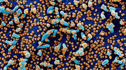 Sars-CoV-2-Viruspartikel (orange) treten aus einer stark infizierten Blutzelle (blau) aus, die einem Patienten entnommen wurde (eingefärbte elektronenmikroskopische Aufnahme).