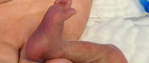 In der Hand einer Pflegekraft liegt der rechte Fuß eines fünf Tage alten Jungen.