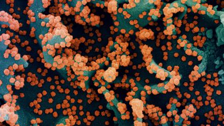 Sars-CoV-2 unterwirft befallene Zellen seiner eigenen Vermehrung. Die meisten sterben durch die Produktion neuer Viren ab.