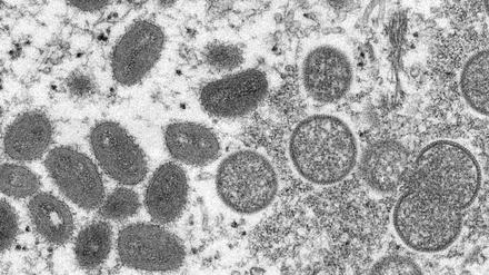 Diese elektronenmikroskopische Aufnahme aus dem Jahr 2003, die von den Centers for Disease Control and Prevention zur Verfügung gestellt wurde, zeigt reife, ovale Affenpockenviren (l) und kugelförmige unreife Virionen (r), die aus einer menschlichen Hautprobe im Zusammenhang mit dem Präriehundeausbruch von 2003 stammt. 