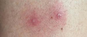 Das vom Institute of Tropical Medicine Antwerp zur Verfügung gestellte Foto zeigt Hautsymptome von Affenpocken-Patienten.