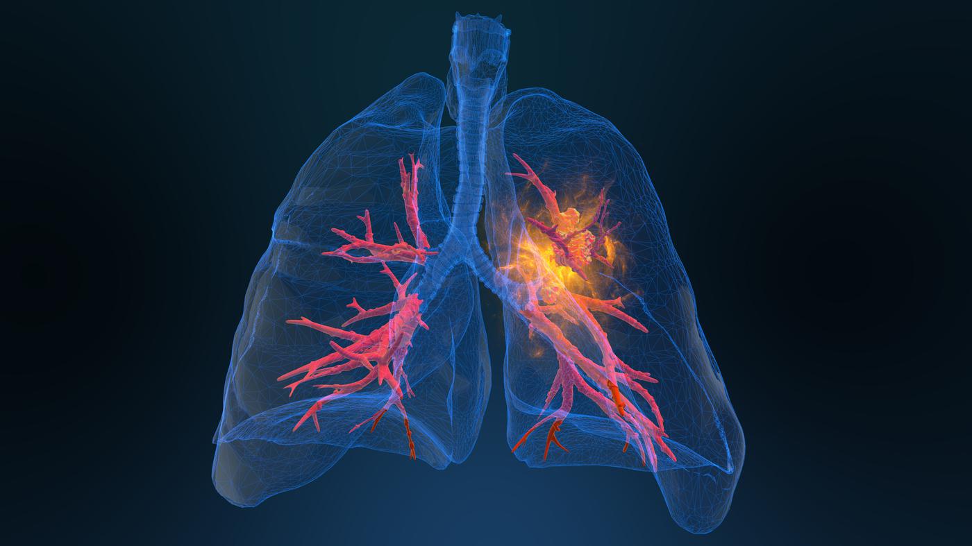 Rilevazione precoce dell’inalazione: le nanoparticelle rilevano il cancro ai polmoni