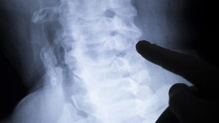 Die Diagnose und Behandlung von Morbus Bechterew wurde erst Anfang der 2000er Jahre genauer erforscht.