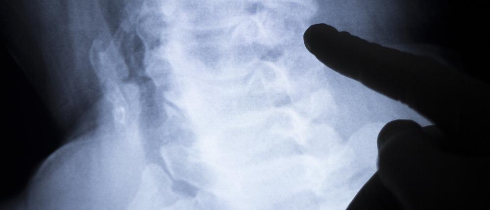 Die Diagnose und Behandlung von Morbus Bechterew wurde erst Anfang der 2000er Jahre genauer erforscht.