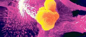 Gefahr gebannt. Auf dieser rasterelektronenmikroskopischen Aufnahme ist gut zu erkennen, wie Krebszellen (gelb eingefärbt) einer Abwehrzelle des Immunsystems („Fresszelle“, violett eingefärbt) „ins Netz gehen“ und verdaut werden. Eine Chemotherapie kann solche Strategien des Körpers gegen Tumorzellen offenbar stimulieren. Foto: Mauritius