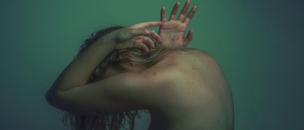 Akne kann die Risiken für Depressionen, Ängstlichkeit und soziale Isolation erhöhen.