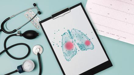 Mit mehr als drei Millionen Todesfällen weltweit belegte COPD im Jahr 2019 den dritten Platz auf der Liste der häufigsten Todesursachen - hinter der koronaren Herzerkrankung und dem Schlaganfall.