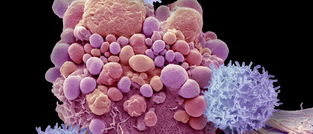 Rasterelektronenmikrographie von T-Zellen und Krebszellen im Hirn. Die CAR-T-Zell-Therapie wird seit wenigen Jahren in der Krebsmedizin eingesetzt. In der aktuellen Studie wurde die CAR-T-Zell-Therapie zum ersten Mal jenseits der Krebsmedizin angewandt: bei fünf Menschen mit systemischen Lupus erythematodes (SLE).
