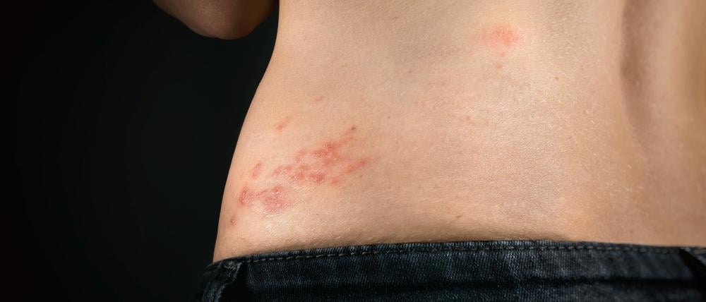 Die Gürtelrose tritt besonders häufig im Bauch und unteren Rückenbereich auf.