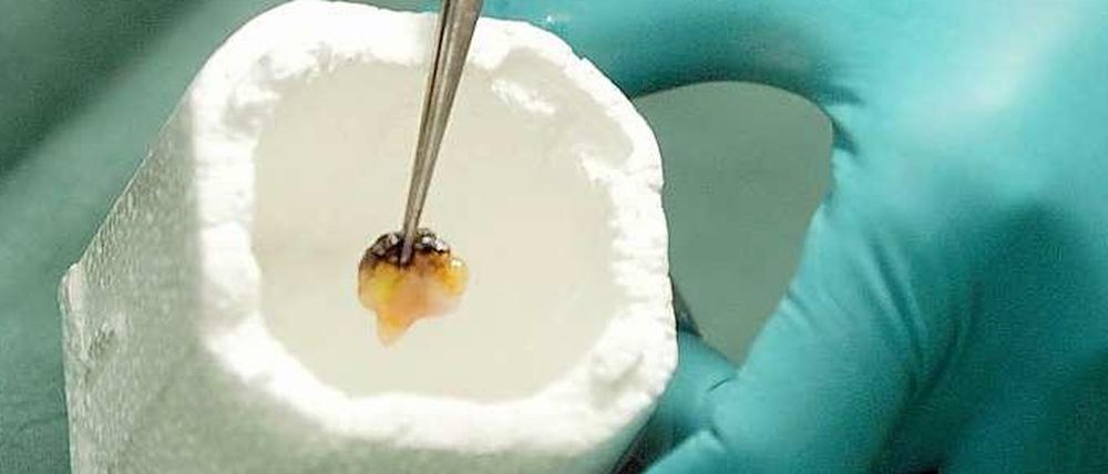Forscher ergreift von Krebs befallenes Gewebe mit einer Pinzette.