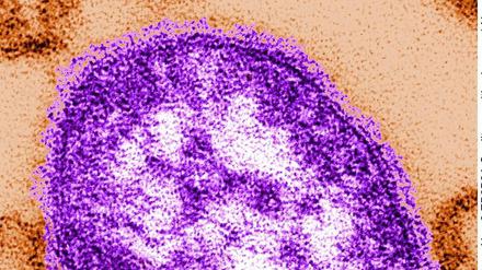 Hochansteckend. Ein Masernvirus unter dem Elektronenmikroskop.