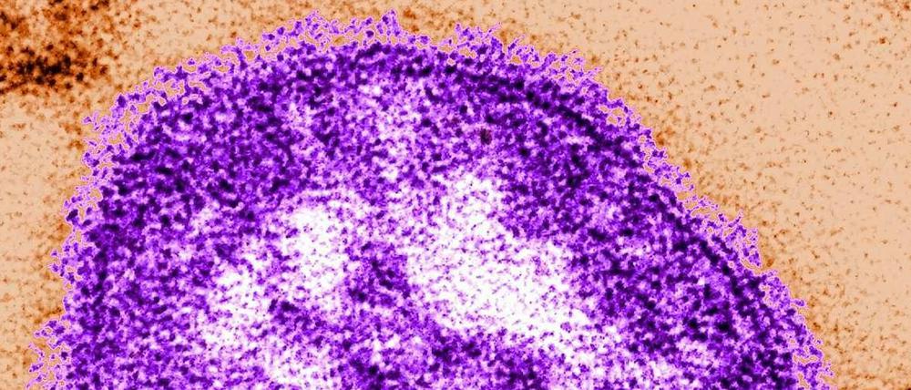Hochansteckend. Ein Masernvirus unter dem Elektronenmikroskop.