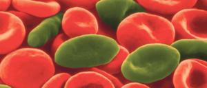 (Nicht-) Korrigieren. Per Gentechnik kann das Gen, das rote Blutkörperchen zu Sichelzellen (grün) macht, korrigiert werden. Doch die Mutation schützt auch vor Malaria.