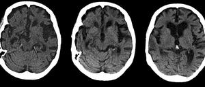 Ausgehöhlt. Das Gehirn eines Alzheimer-Patienten in einer computertomographischen Aufnahme.