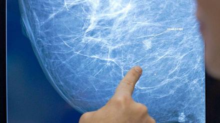 Bis 2025 könnten jährlich 20 Millionen Menschen weltweit an Krebs erkranken - rund 40 Prozent mehr als derzeit.