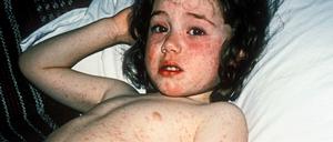 Ansteckend. Das Masernvirus ist hochinfektiös. 90 Prozent der Menschen, die nicht immun sind und mit einem Erkrankten in Berührung kommen, stecken sich an.