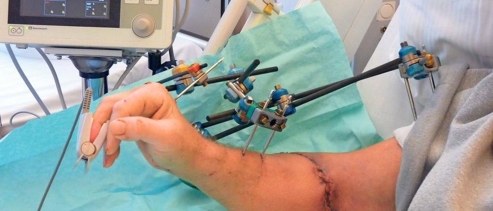 Operation gelungen. Das Foto zeigt den rechten replantierten Arm. Ein Clip misst kontinuierlich die Sauerstoffsättigung im Blut.