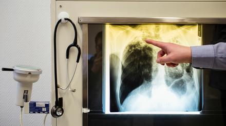 Vor mehr als 100 Jahren bekam Robert Koch den Nobelpreis für die Entdeckung des Tuberkulose-Erregers. Die Infektionskrankheit ist aber auch heute noch nicht besiegt.