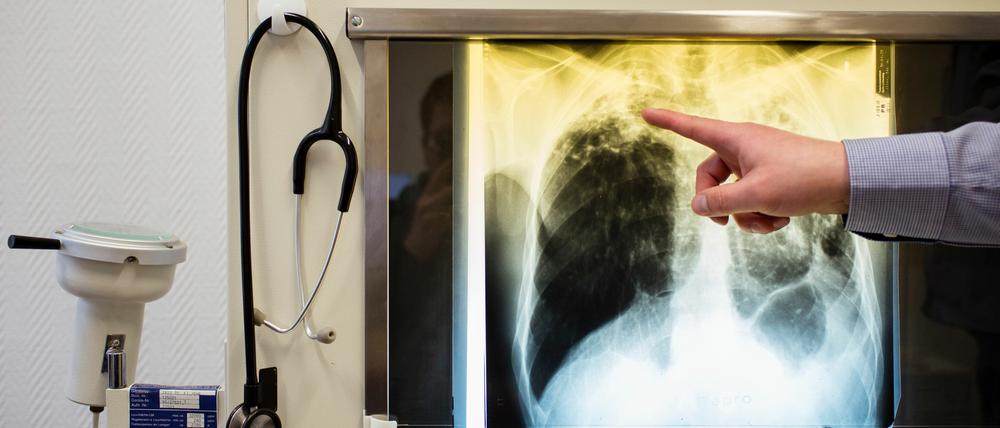 Vor mehr als 100 Jahren bekam Robert Koch den Nobelpreis für die Entdeckung des Tuberkulose-Erregers. Die Infektionskrankheit ist aber auch heute noch nicht besiegt.