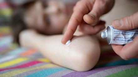 Experten geben an, dass jedes Jahr zwei Millionen Kinder in Deutschland an Neurodermitis leiden.
