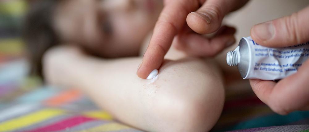 Experten geben an, dass jedes Jahr zwei Millionen Kinder in Deutschland an Neurodermitis leiden.