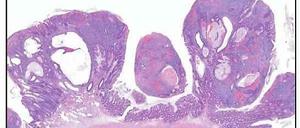 Wucherung. Im Darm der Versuchtiere entstanden Geschwülste aus Stammzellen. 