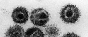 Elektronenmikroskopische Aufnahme mehrerer HIV (Humane Immunschwäche-Viren) Erreger der Immunschwäche-Krankheit Aids. In einem sehr seltenen Fall hat ein weiterer Patient durch eine spezielle Behandlung seine HIV-Infektion offenbar überwunden.