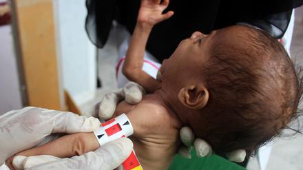 Ein unterernährtes Baby in Jemen. Der Anteil an unterernährten Menschen steigt von Jahr zu Jahr.