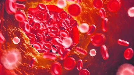 Illustration einer verstopften Arterie.