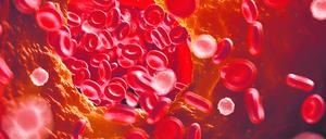 Illustration einer verstopften Arterie.