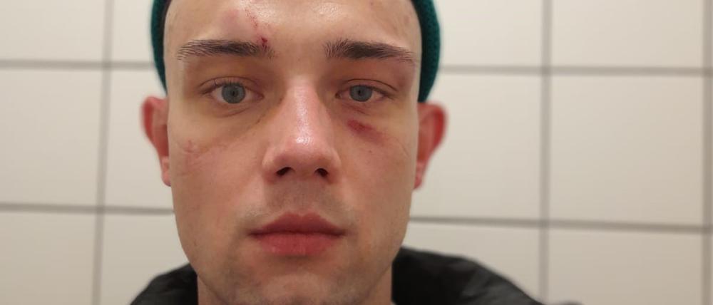 Der junge Ukrainer nach der Attacke: die Ärzte stellen Gesichtsprellungen und eine Verletzung an der Hand fest. 