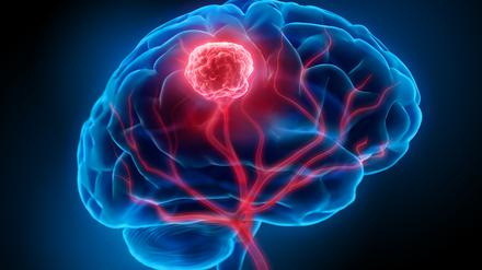 Hirntumore (hier rot von einer Magnetresonanzbildgebung dargestellt) können durch die Analyse von Genaktivität genauer diagnostiziert und therapiert werden. 