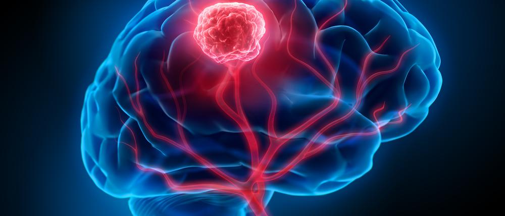 Hirntumore (hier rot von einer Magnetresonanzbildgebung dargestellt) können durch die Analyse von Genaktivität genauer diagnostiziert und therapiert werden. 
