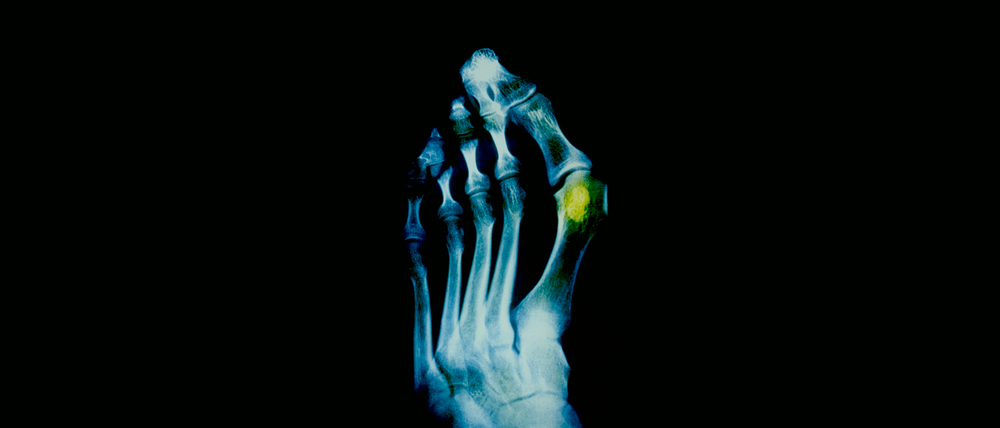 Hallux Valgus