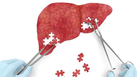 Hepatitis B kann die Leber dauerhaft schädigen.