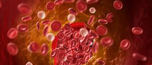 Illustration einer verstopften Arterie.