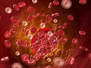 Illustration einer verstopften Arterie.