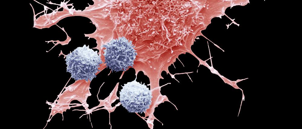 T-Zellen der Patienten können, gentechnisch aufgepeppt, wieder fit für den Kampf gegen Krebs gemacht werden. Blutkrebs können diese „CAR-T-Zellen“ heilen, in Zukunft vielleicht auch solide Tumore. 