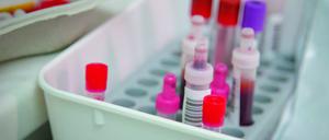An den Blutproben von 111 Patient:innen wurden die Immunfunktionen bestimmt. 