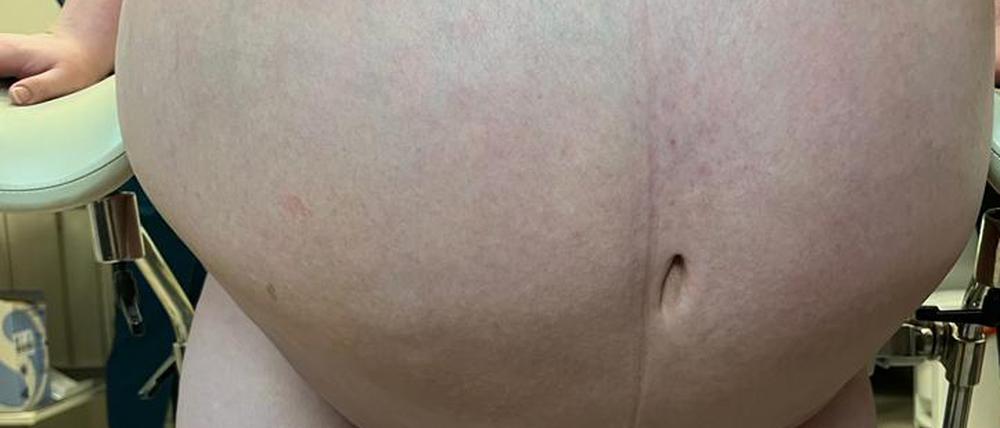 Das von der Universitätsklinik Rzeszow zur Verfügung gestellte Bild zeigt die Patientin vor der Operation.