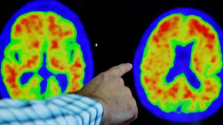 Der Fortschritt der Erkrankung ist auf PET-Scans erkennbar.