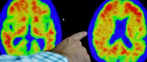 Der Fortschritt der Erkrankung ist auf PET-Scans erkennbar.