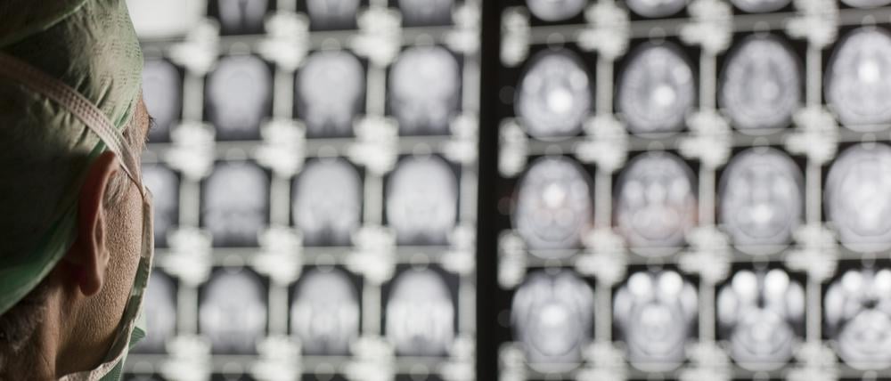 Patienten mit Hirntumoren können mit den meisten Krebsmedikamenten nicht behandelt werden, da diese die Blut-Hirn-Schranke kaum überwinden. 