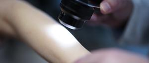 Ein Hautarzt untersucht bei einer Krebsvorsorgeuntersuchung eine Patientin mit einem Auflichtmikroskop. In den vergangenen 20 Jahren hat die Zahl der Krankenhausbehandlungen wegen Hautkrebs stark zugenommen. Die Zahl der Diagnosen von schwarzem und weißem Hautkrebs in Deutschland sind deutlich gestiegen