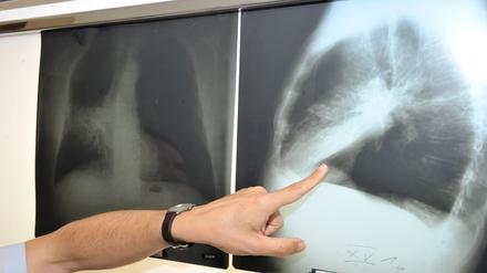 ARCHIV - Die Hand des Leiters der Pneumologie (Lungenheilkunde) zeigt am 17.06.2010 in München (Oberbayern) im Klinikum der Universität München auf ein Röntgenbild einer mit Krebs befallenen Lunge. Die Sterberate für Krebs sinkt in der Europäischen Union (EU) insgesamt - allerdings bei Frauen weniger stark als bei Männern. Foto: Felix Hörhager/dpa +++(c) dpa - Bildfunk+++ | Verwendung weltweit