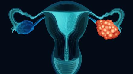 Zum Zeitpunkt der Diagnose leiden viele von Eierstockkrebs betroffene Frauen bereits unter körperlichen Beschwerden.