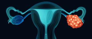 Zum Zeitpunkt der Diagnose leiden viele von Eierstockkrebs betroffene Frauen bereits unter körperlichen Beschwerden.